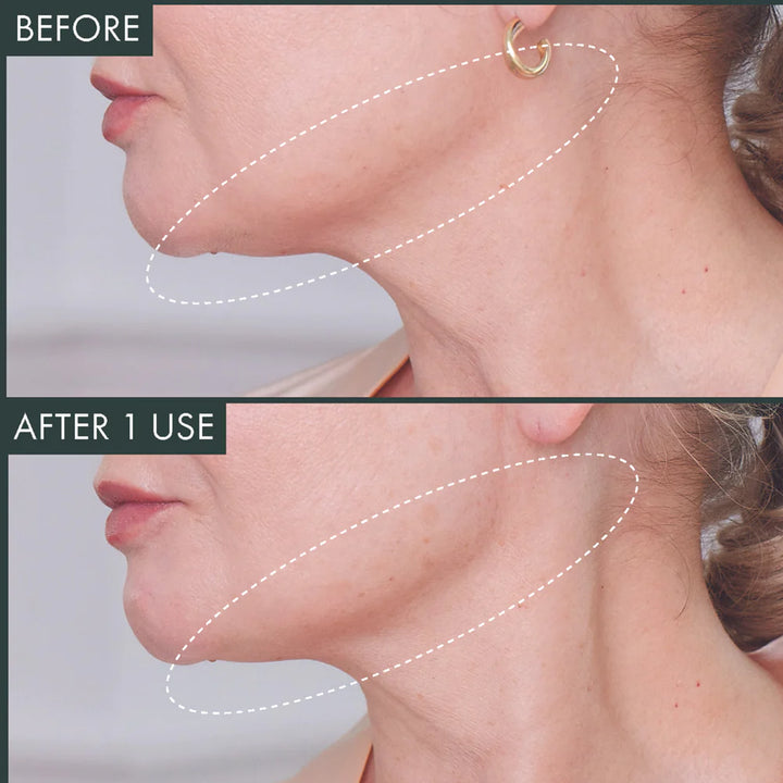 FERMITIF CHIN CONTOUR MASK