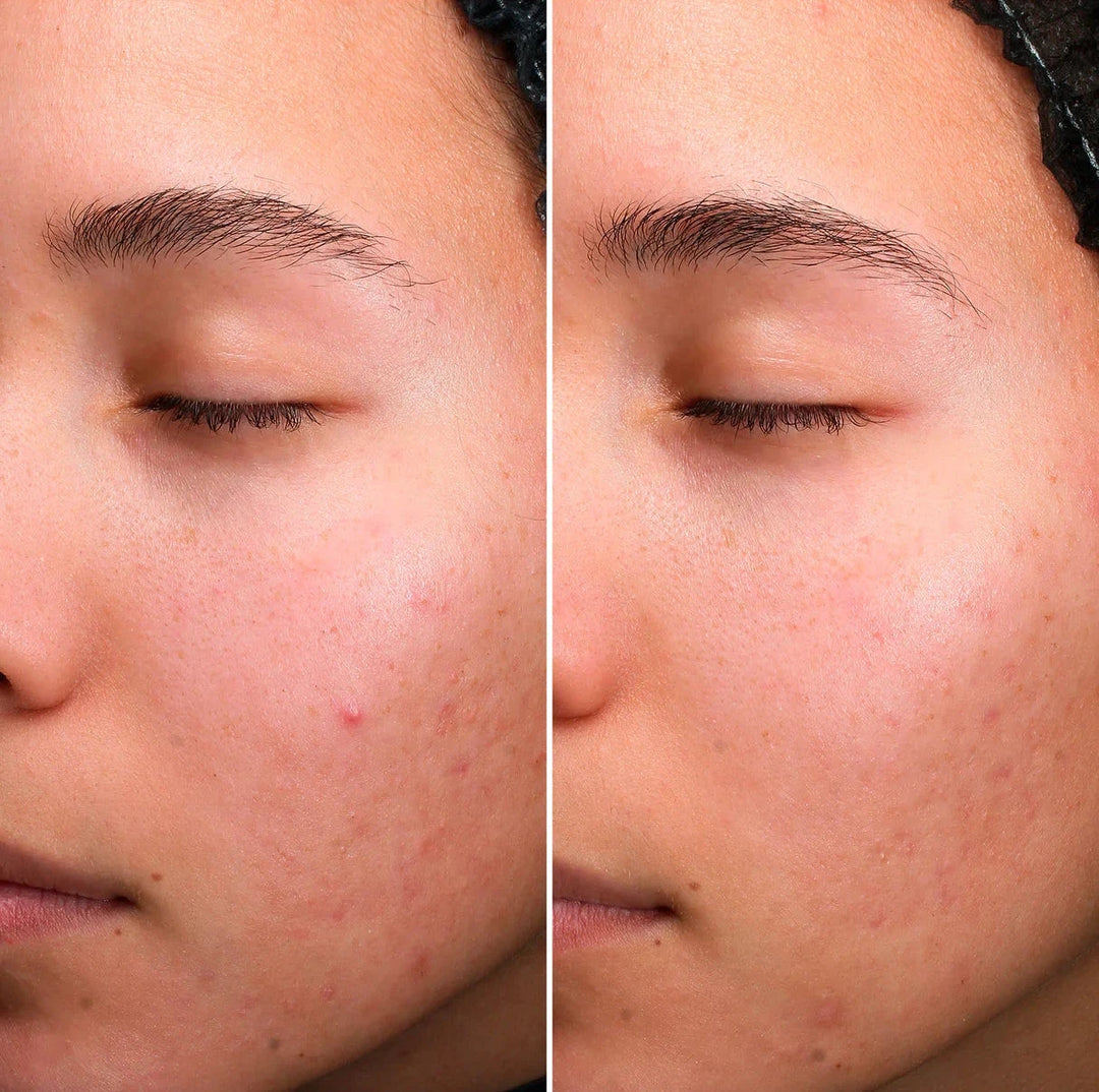 Stop Imperfection Serum [AKN®]