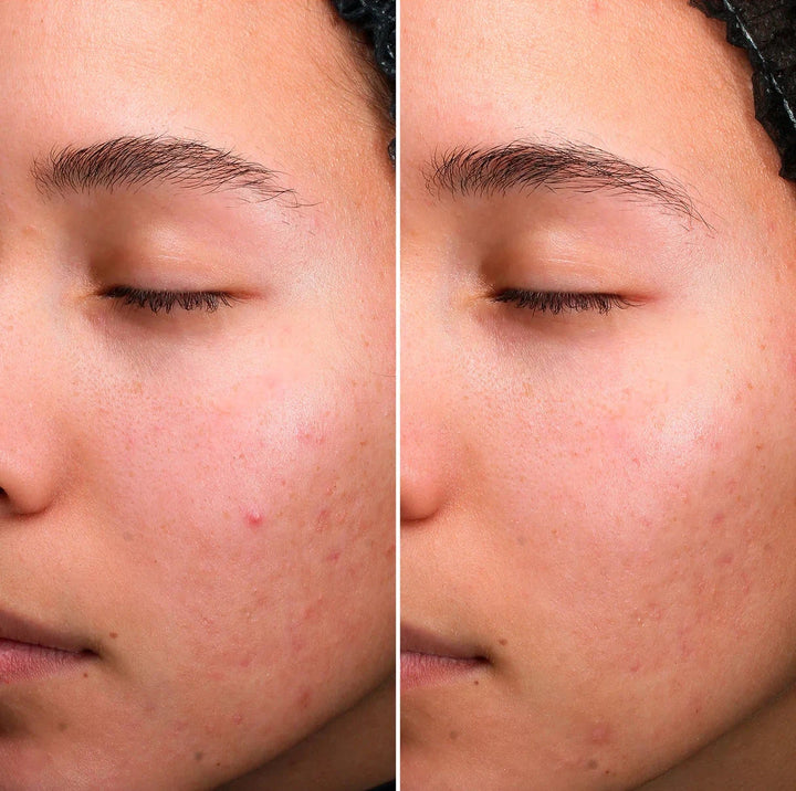 Stop Imperfection Serum [AKN®]