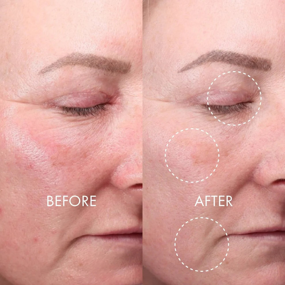 DERMA EXPERT LED Light Treatment